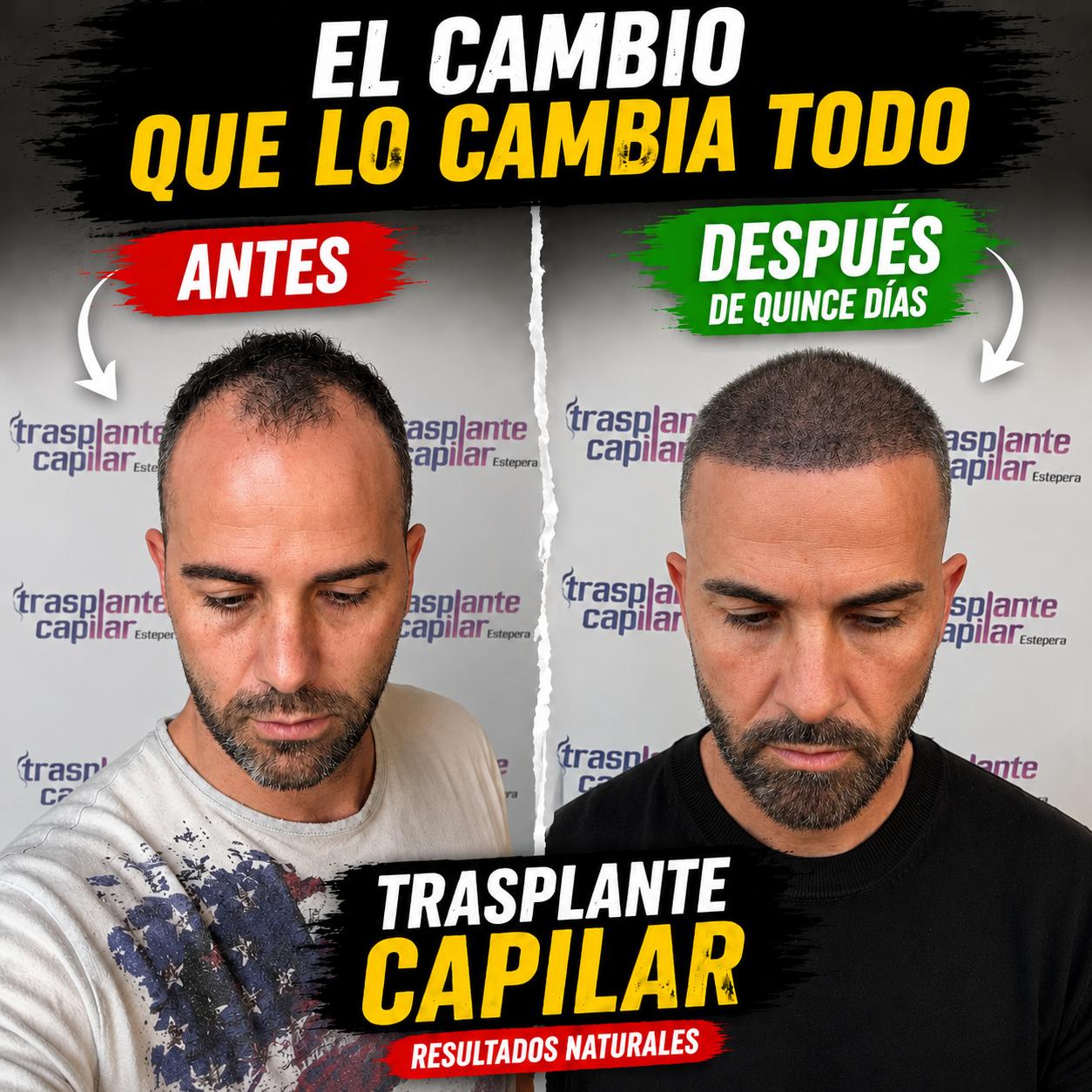 Injerto capilar antes y después a los 15 días de la intervención — paciente de ESTEPERA en Turquía
